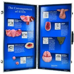 3B Scientific W43089 The Consequences of STDs 3D Display, 69cm Length 