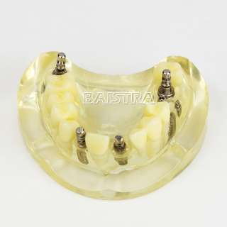 Dental Study Teaching Model Teeth Implant Model  