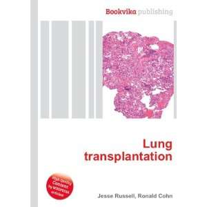  Lung transplantation Ronald Cohn Jesse Russell Books