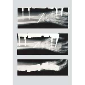  Arm with External Fixation 20x30 poster